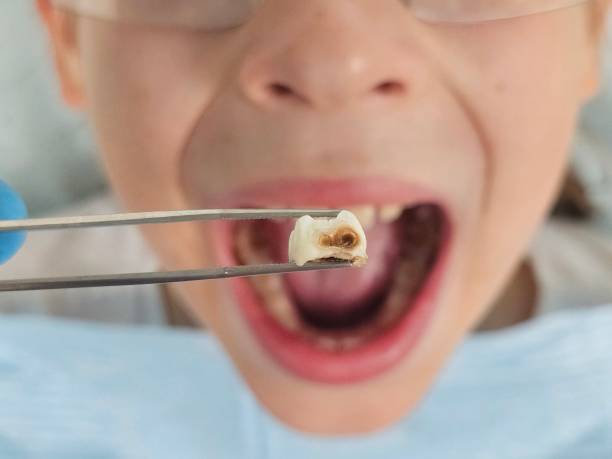 Best Dental Abscess Treatment in Somerset, KY